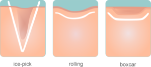 cicatrizes atróficas ou cicatrizes de acne